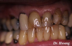 Before-Dental Crown